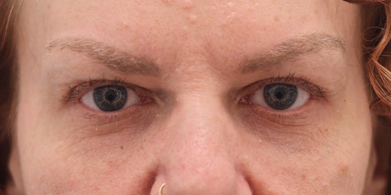 Winged Blepharoplasty Before & After Gallery - Patient 314440 - Image 1