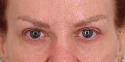 Winged Blepharoplasty Before & After Gallery - Patient 314440 - Image 2