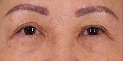 Winged Blepharoplasty Before & After Gallery - Patient 116877 - Image 1