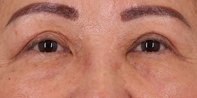 Winged Blepharoplasty Before & After Gallery - Patient 116877 - Image 2