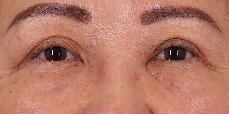 Winged Blepharoplasty Before & After Gallery - Patient 116877 - Image 2