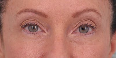 Winged Blepharoplasty Before & After Gallery - Patient 158760 - Image 2