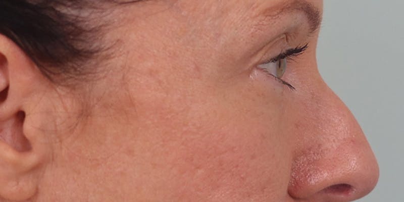 Winged Blepharoplasty Before & After Gallery - Patient 158760 - Image 3
