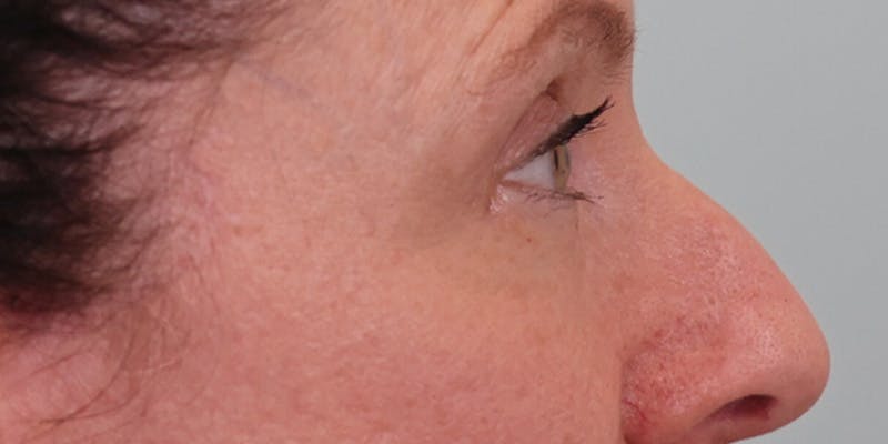 Winged Blepharoplasty Before & After Gallery - Patient 158760 - Image 4