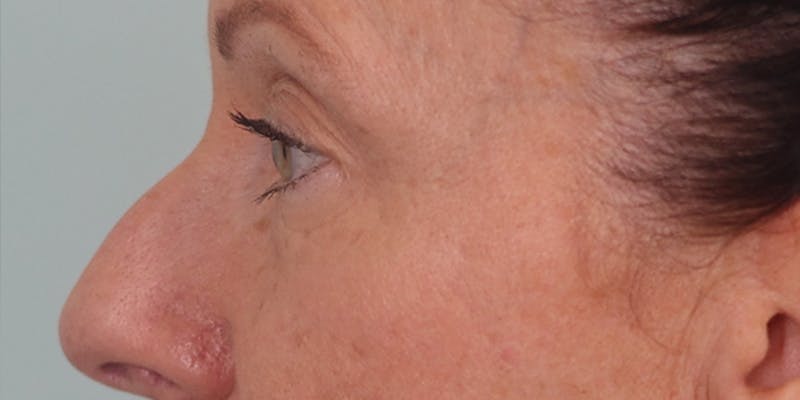 Winged Blepharoplasty Before & After Gallery - Patient 158760 - Image 5