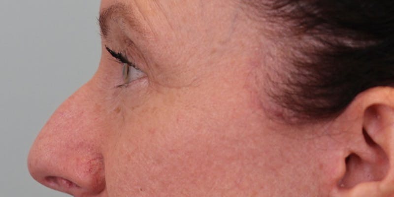 Winged Blepharoplasty Before & After Gallery - Patient 158760 - Image 6