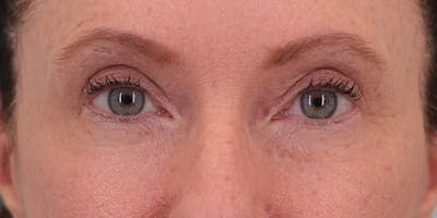 Winged Blepharoplasty Before & After Gallery - Patient 158760 - Image 1