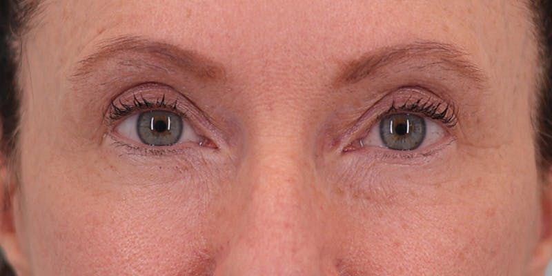 Winged Blepharoplasty Before & After Gallery - Patient 158760 - Image 1