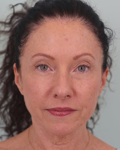 Facelift Before & After Gallery - Patient 155730 - Image 1