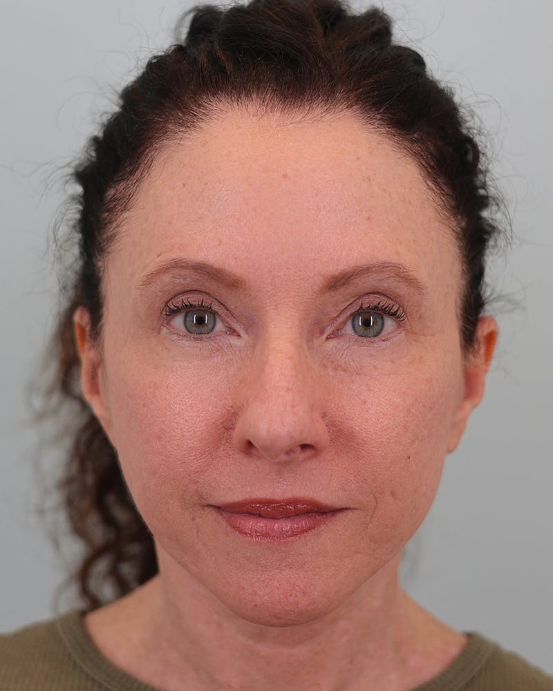Facelift Before & After Gallery - Patient 155730 - Image 2