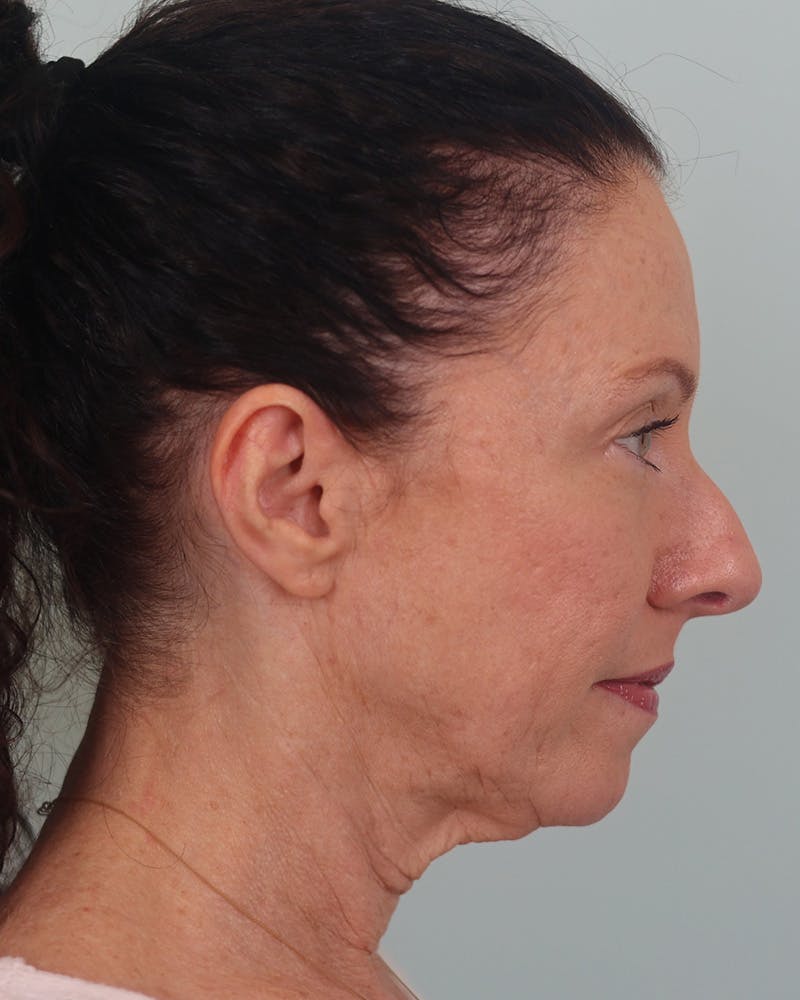Facelift Before & After Gallery - Patient 155730 - Image 3