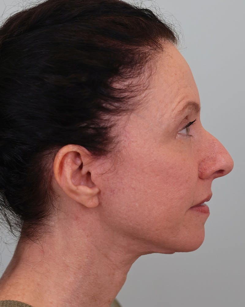 Facelift Before & After Gallery - Patient 155730 - Image 4