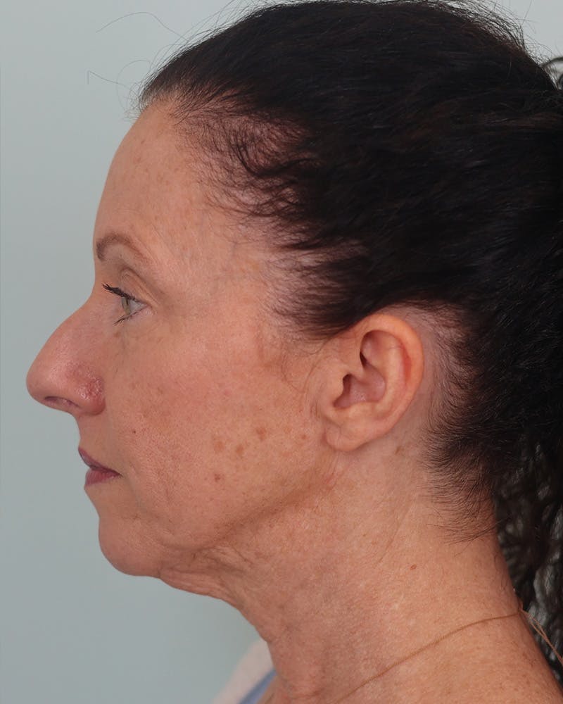 Facelift Before & After Gallery - Patient 155730 - Image 5