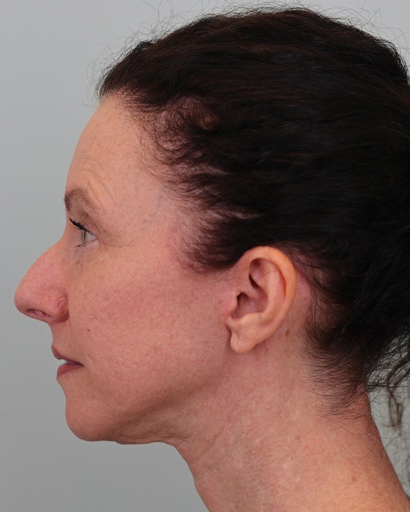 Facelift Before & After Gallery - Patient 155730 - Image 6