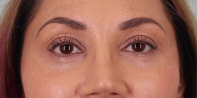 Winged Blepharoplasty Before & After Gallery - Patient 392490 - Image 1