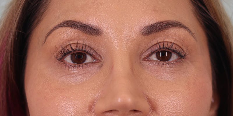 Winged Blepharoplasty Before & After Gallery - Patient 392490 - Image 1
