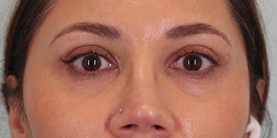 Winged Blepharoplasty Before & After Gallery - Patient 392490 - Image 2