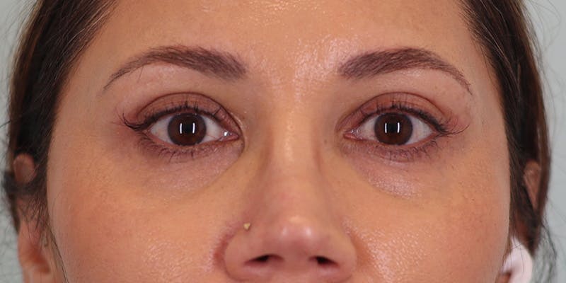 Winged Blepharoplasty Before & After Gallery - Patient 392490 - Image 2