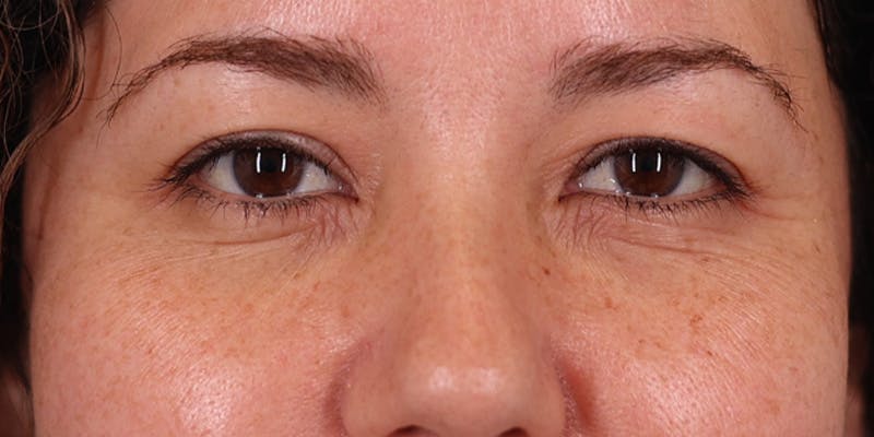 Winged Blepharoplasty Before & After Gallery - Patient 967176 - Image 1