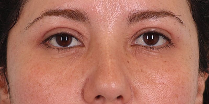 Winged Blepharoplasty Before & After Gallery - Patient 967176 - Image 2
