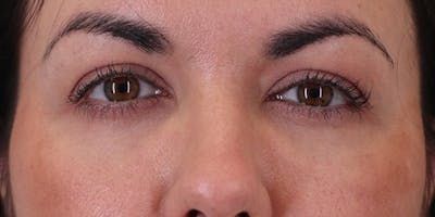 Winged Blepharoplasty Before & After Gallery - Patient 369984 - Image 2