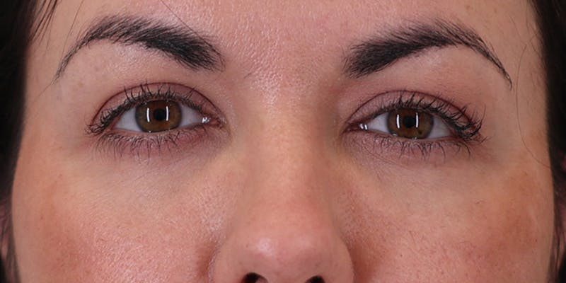 Winged Blepharoplasty Before & After Gallery - Patient 369984 - Image 2