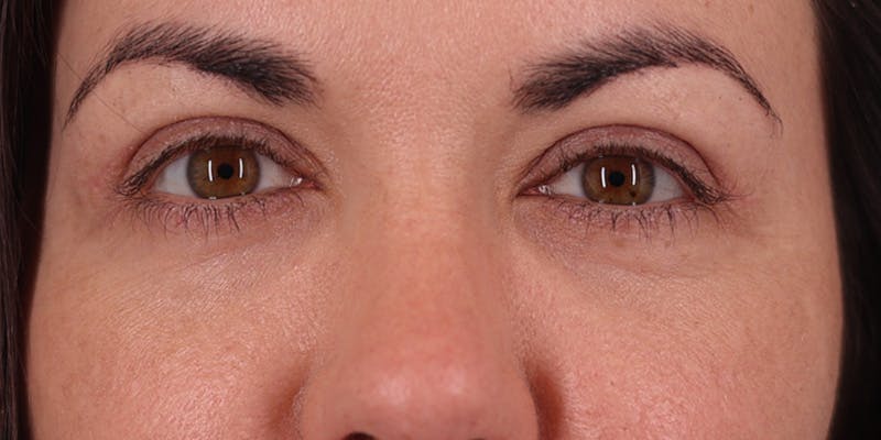 Winged Blepharoplasty Before & After Gallery - Patient 369984 - Image 1