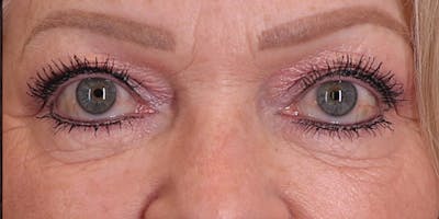 Facial Fat Transfer Before & After Gallery - Patient 931475 - Image 1