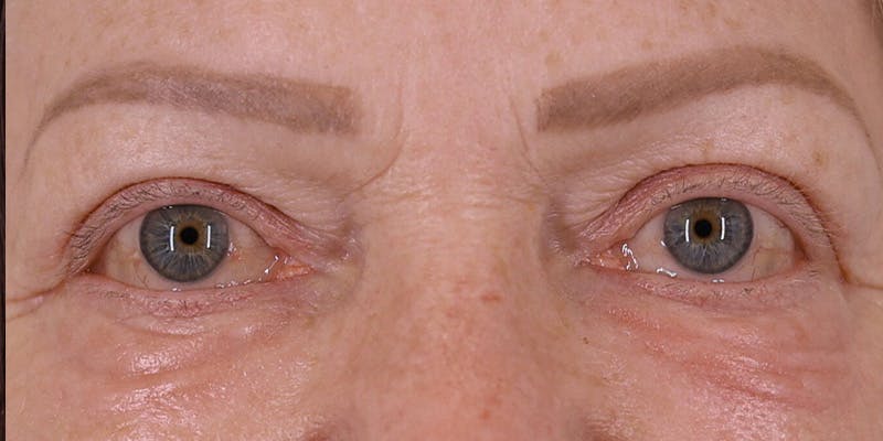 Winged Blepharoplasty Before & After Gallery - Patient 291791 - Image 2