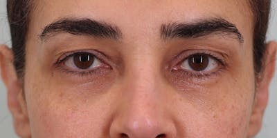 Winged Blepharoplasty Before & After Gallery - Patient 219355 - Image 1