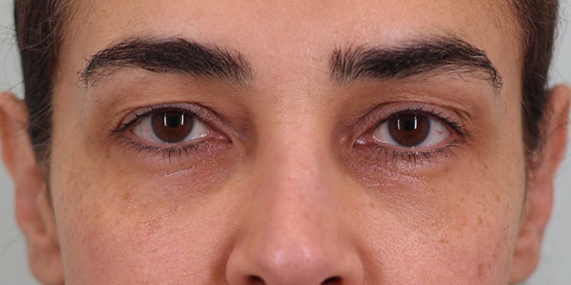 Winged Blepharoplasty Before & After Gallery - Patient 219355 - Image 1