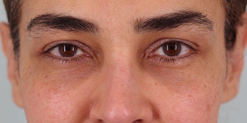 Winged Blepharoplasty Before & After Gallery - Patient 219355 - Image 2