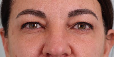 Winged Blepharoplasty Before & After Gallery - Patient 241919 - Image 1