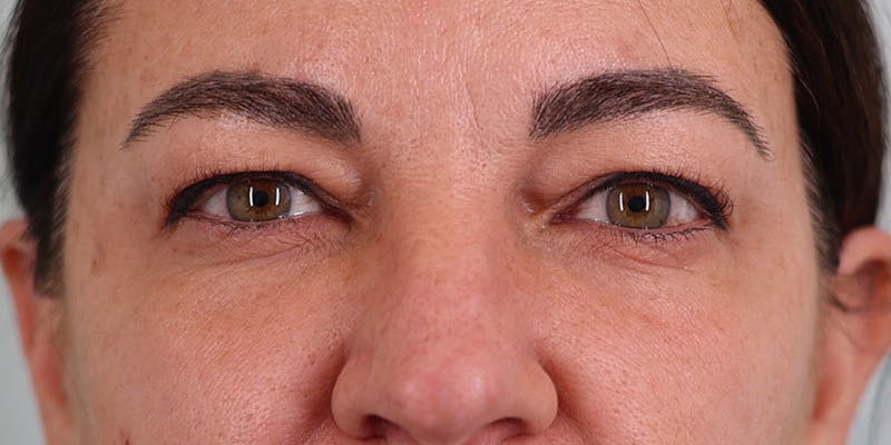 Winged Blepharoplasty Before & After Gallery - Patient 241919 - Image 1