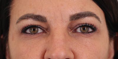 Winged Blepharoplasty Before & After Gallery - Patient 241919 - Image 2