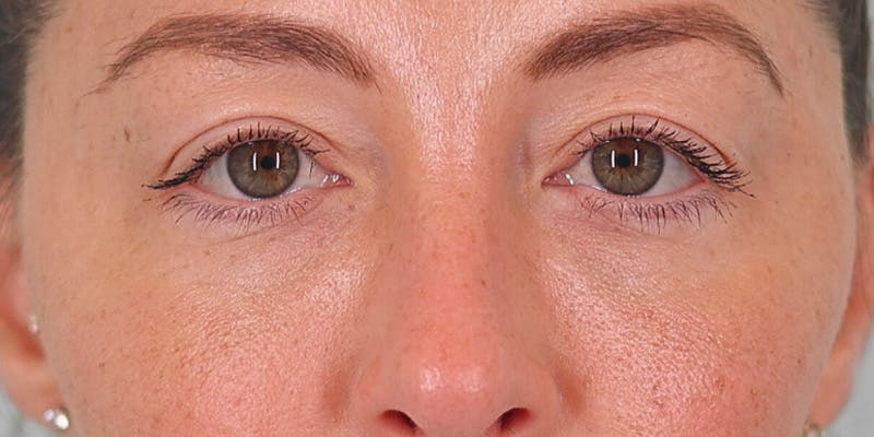 Winged Blepharoplasty Before & After Gallery - Patient 415864 - Image 1