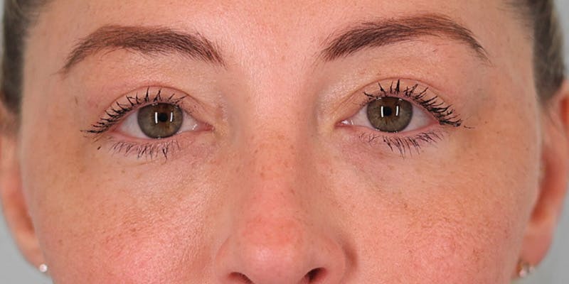 Winged Blepharoplasty Before & After Gallery - Patient 415864 - Image 2