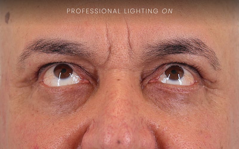 Winged Blepharoplasty Before & After Gallery - Patient 401906 - Image 6