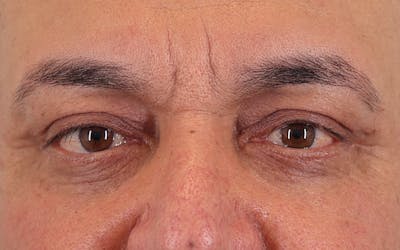 Lower Blepharoplasty Before & After Gallery - Patient 396746 - Image 2