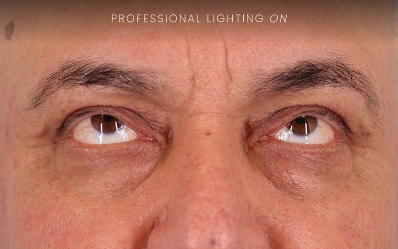Winged Blepharoplasty Before & After Gallery - Patient 401906 - Image 4