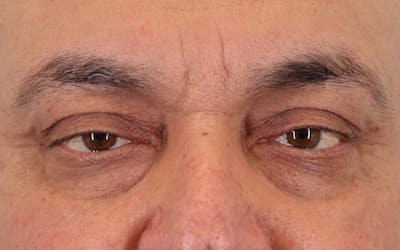 Lower Blepharoplasty Before & After Gallery - Patient 396746 - Image 1