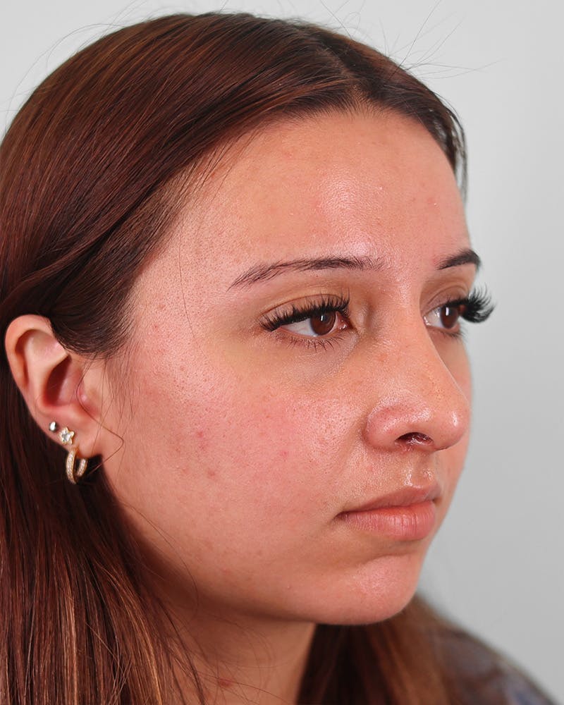 Rhinoplasty Before & After Gallery - Patient 270596 - Image 2