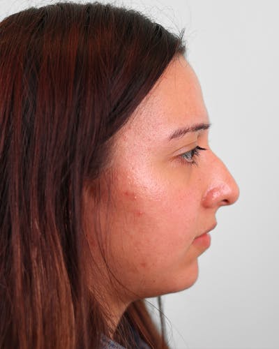 Rhinoplasty Before & After Gallery - Patient 270596 - Image 1