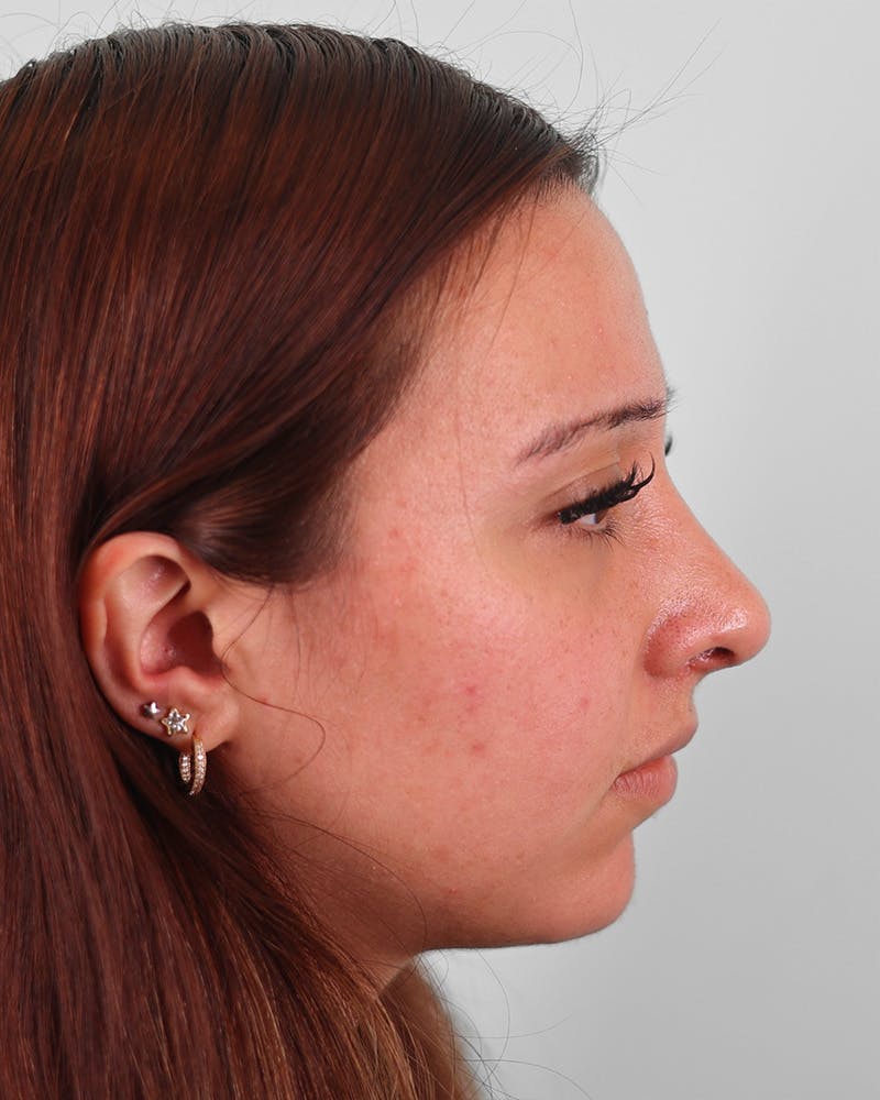 Rhinoplasty Before & After Gallery - Patient 270596 - Image 4