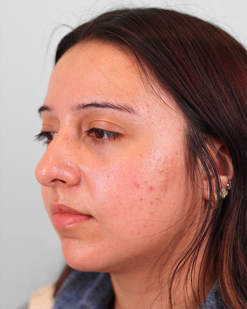 Rhinoplasty Before & After Gallery - Patient 270596 - Image 5