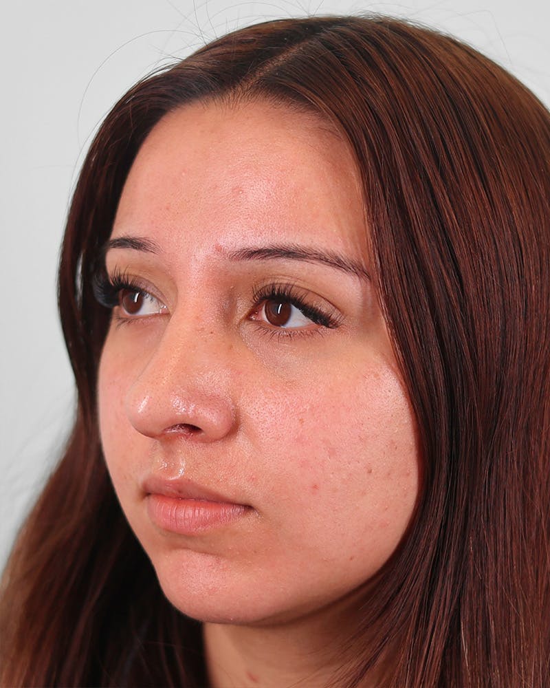 Rhinoplasty Before & After Gallery - Patient 270596 - Image 6