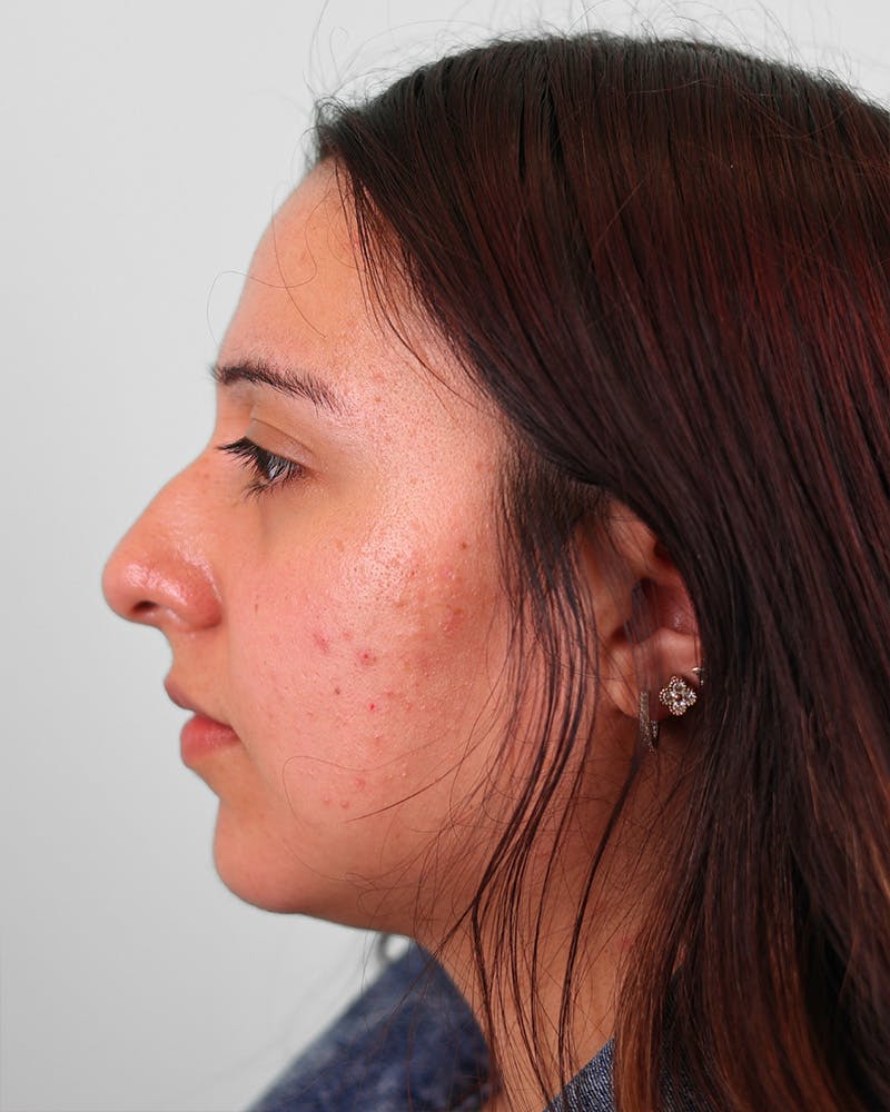 Rhinoplasty Before & After Gallery - Patient 270596 - Image 7