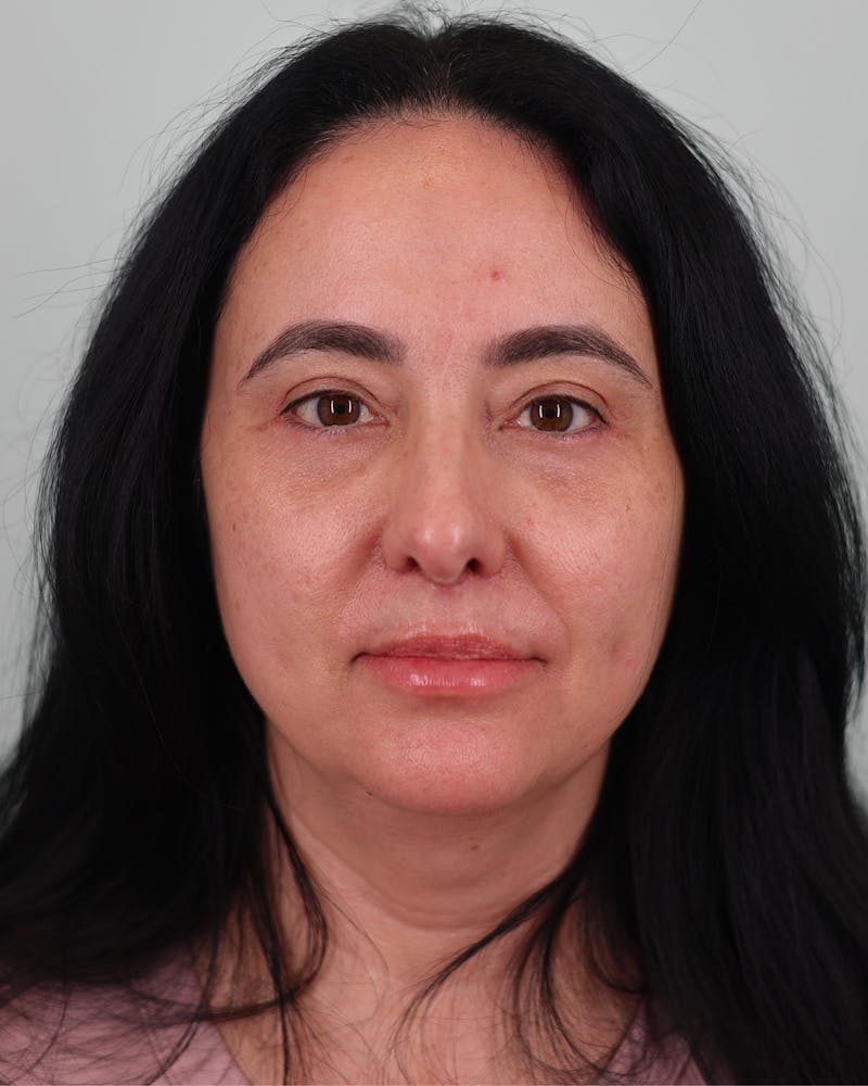 Facial Fat Transfer Before & After Gallery - Patient 128263 - Image 2
