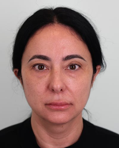 Facial Fat Transfer Before & After Gallery - Patient 128263 - Image 1