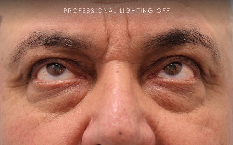Winged Blepharoplasty Before & After Gallery - Patient 401906 - Image 5